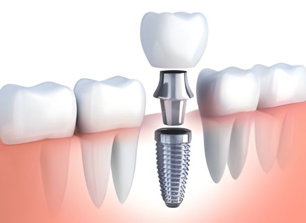 Ilustración 3D de un implante dental desglosado con tornillo, pilar y corona entre varios dientes sobre encía rosada.