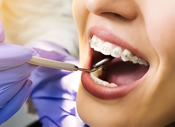 Primer plano de una paciente con brackets metálicos en los dientes mientras el dentista revisa su boca con un espejo e instrumento dental.