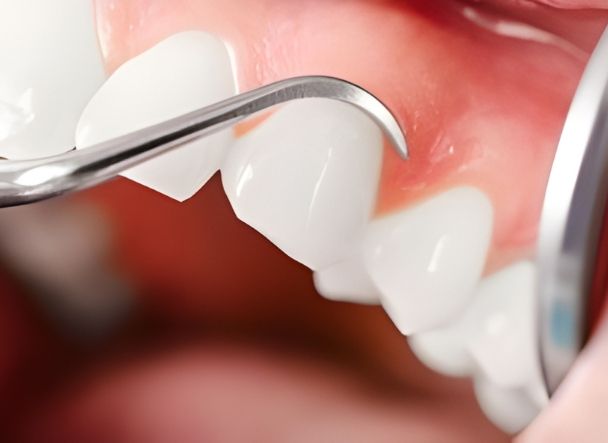 Primer plano de unos dientes blancos y la encía durante una limpieza con instrumento periodontal metálico.